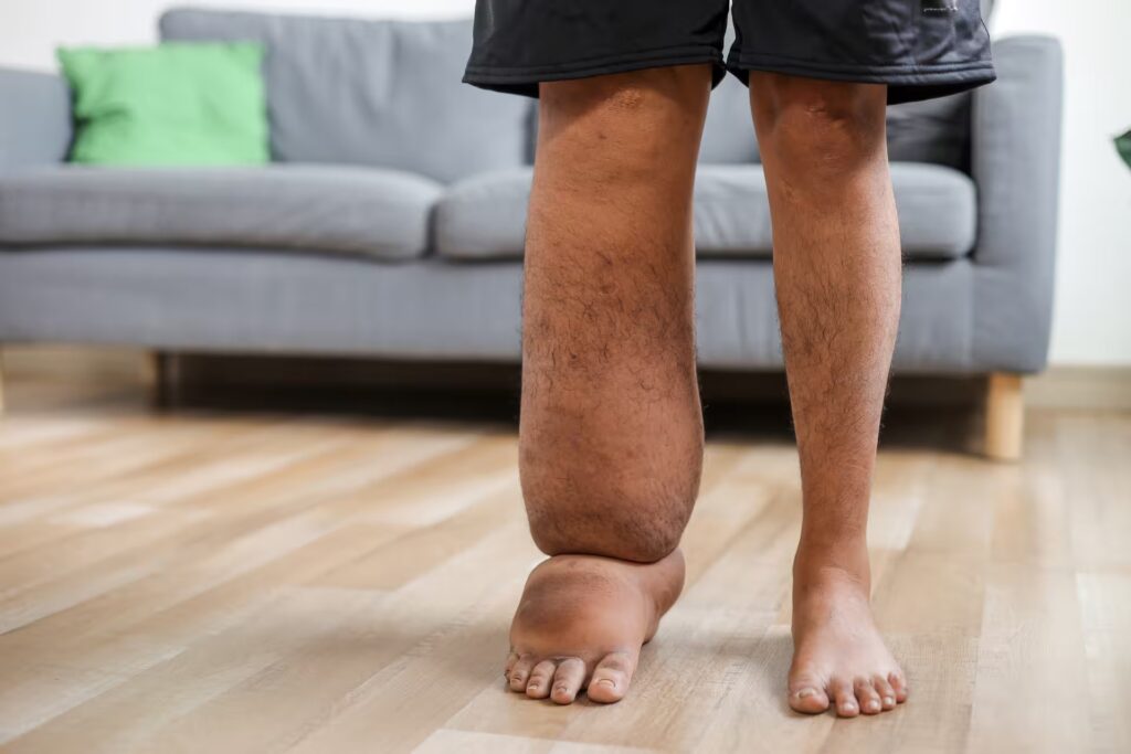 close up of leg severely swollen due to lymphatic 2025 08 27 04 09 14 utc converted