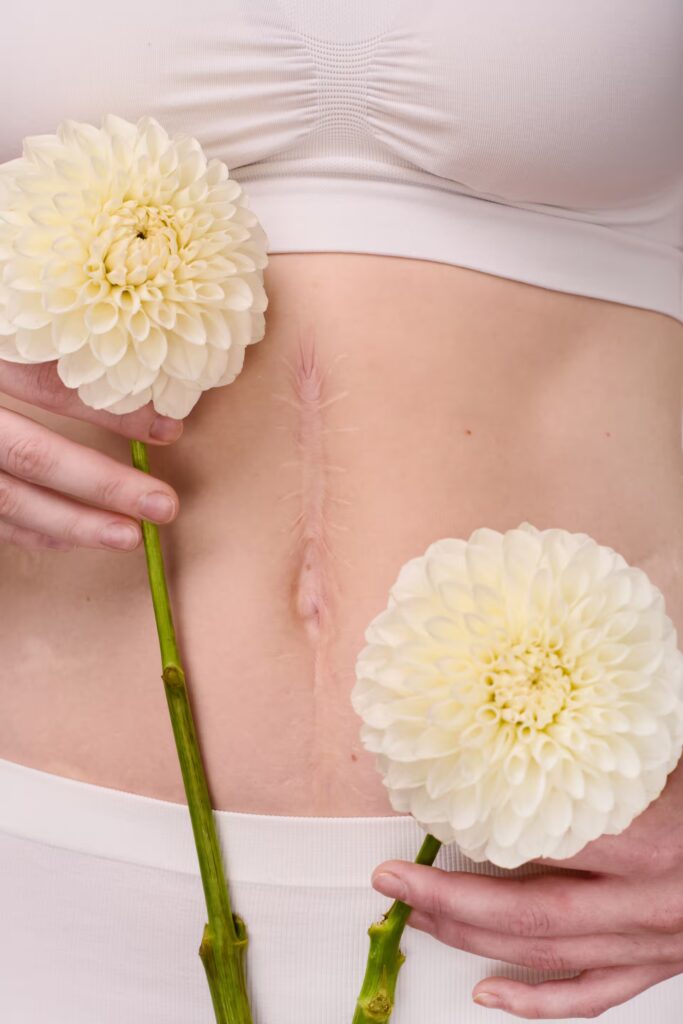 woman with scar on body holding flowers 2025 02 11 15 41 03 utc converted